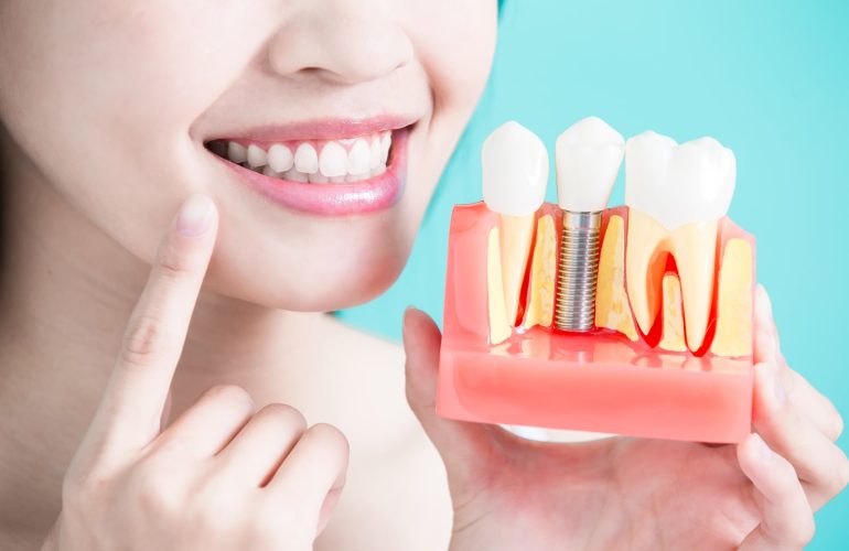 dental-implants-model-min